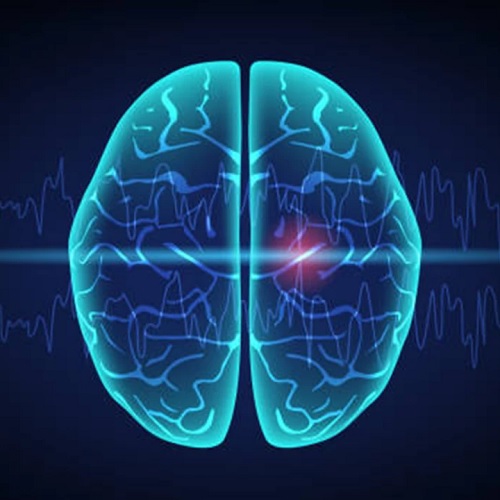 Beyin Anevrizması Neden Olur?