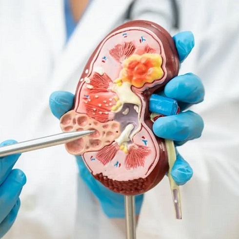 Niye Niçin Böbrek Taşı Olur