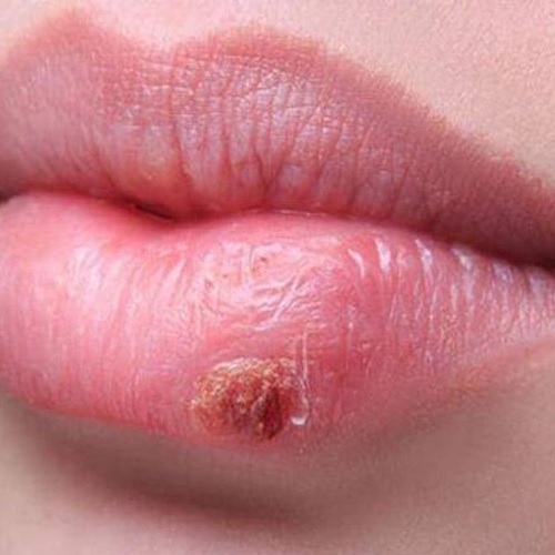 Niye Niçin Sürekli Dudak Uçuklaması olur