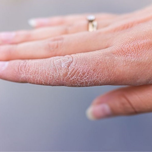 Niye Niçin Kışın Eller Çatlar