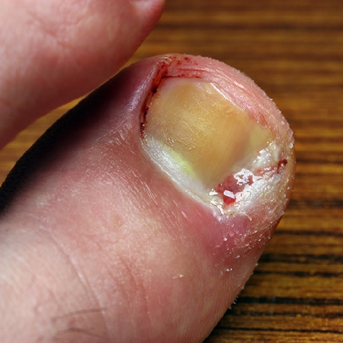 Tırnak Batması Olur Sebebi Nedir